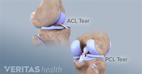 what is a pcl rupture